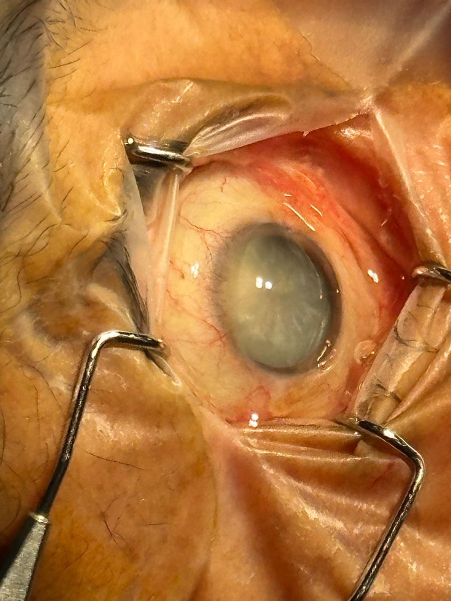 Acercamiento quirúrgico de un ojo con catarata madura: el cristalino se ve opaco y blanquecino